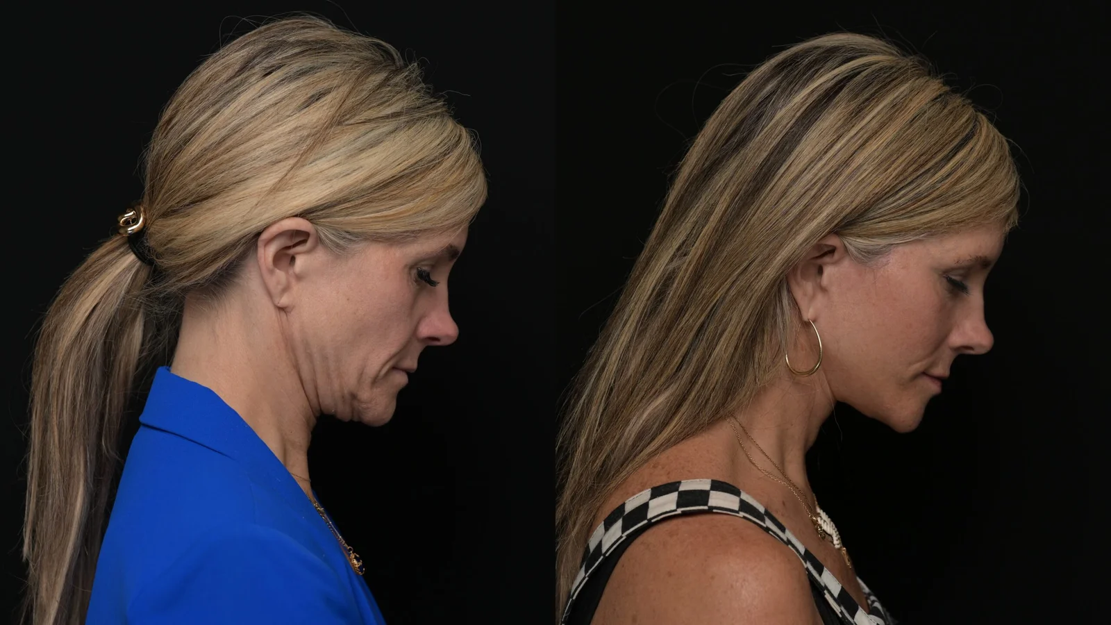 Before-and-after photograph, deep plane facelift and neck lift
