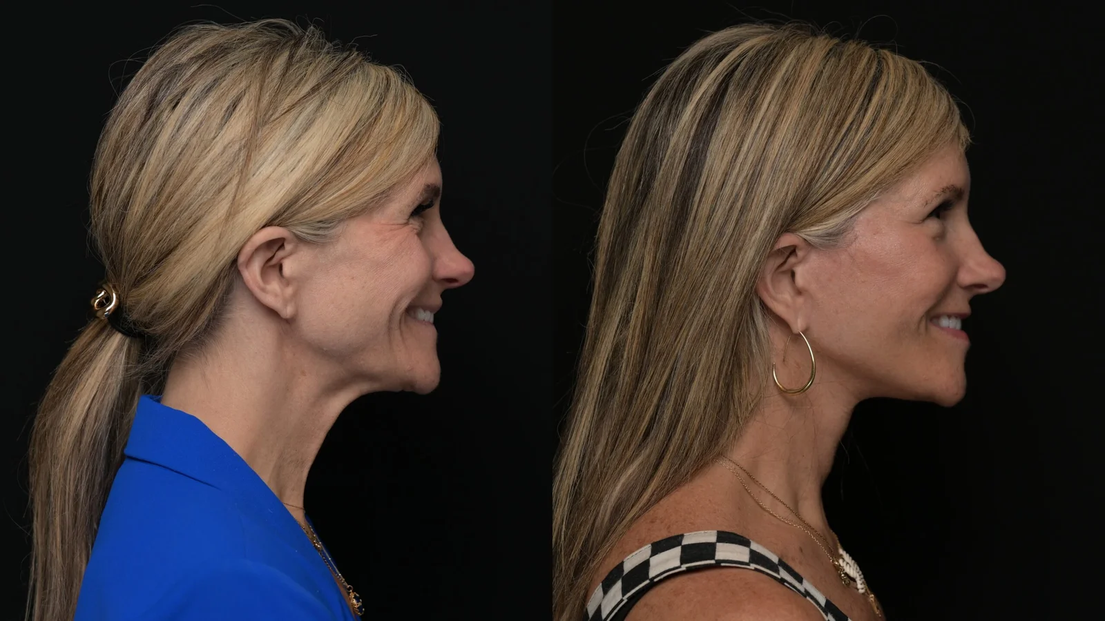 Before-and-after photograph, deep plane facelift and neck lift
