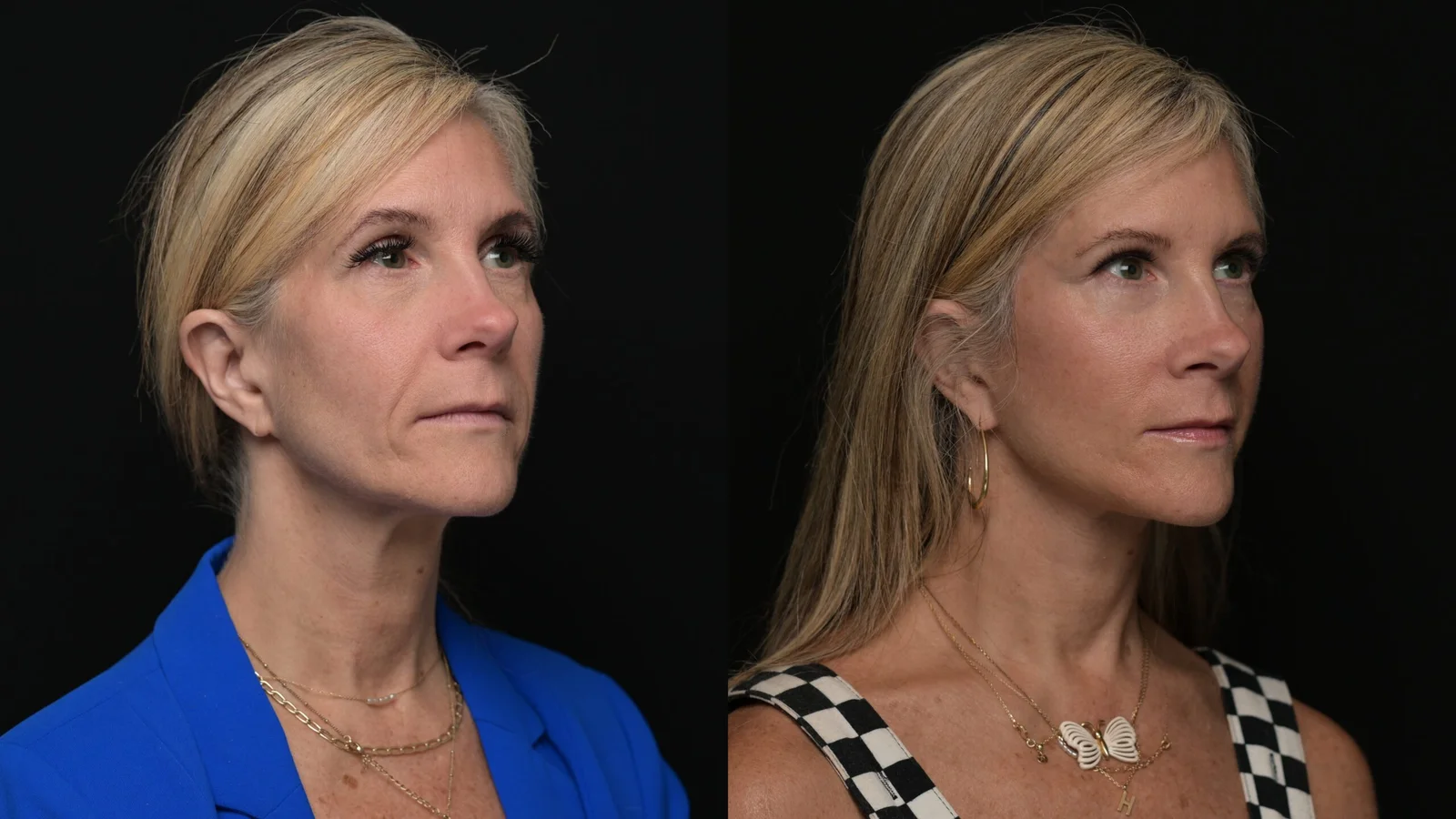 Before-and-after photograph, deep plane facelift and neck lift