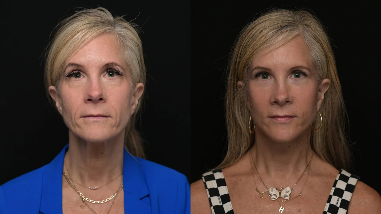Before-and-after photograph, deep plane facelift and neck lift