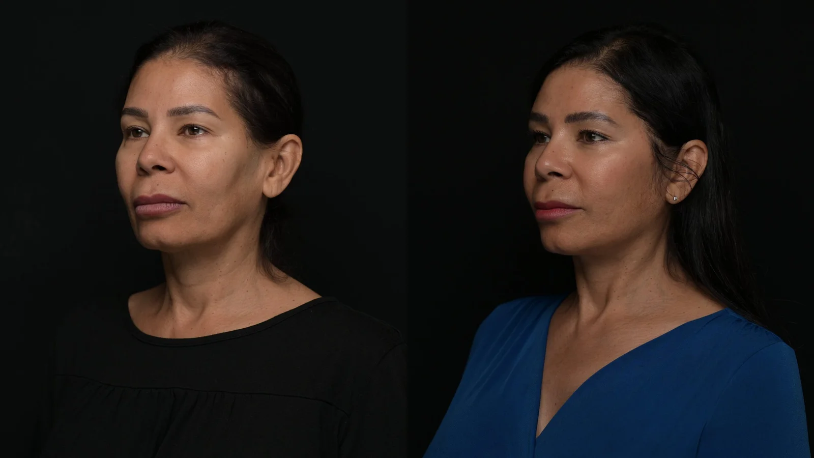 Before-and-after photograph, deep plane facelift and neck lift