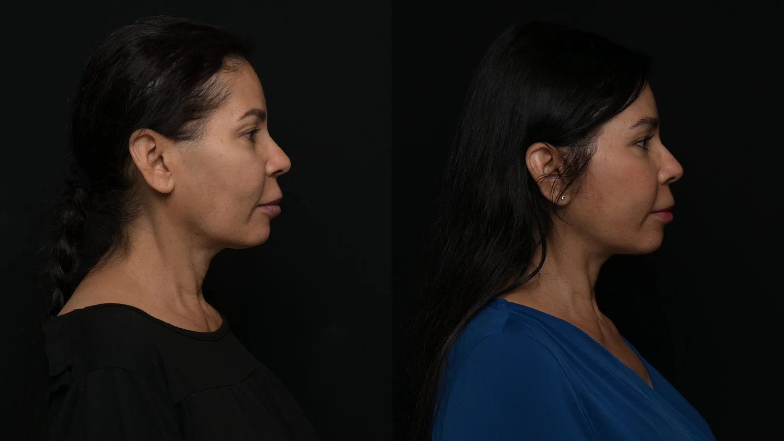 Before-and-after photograph, deep plane facelift and neck lift