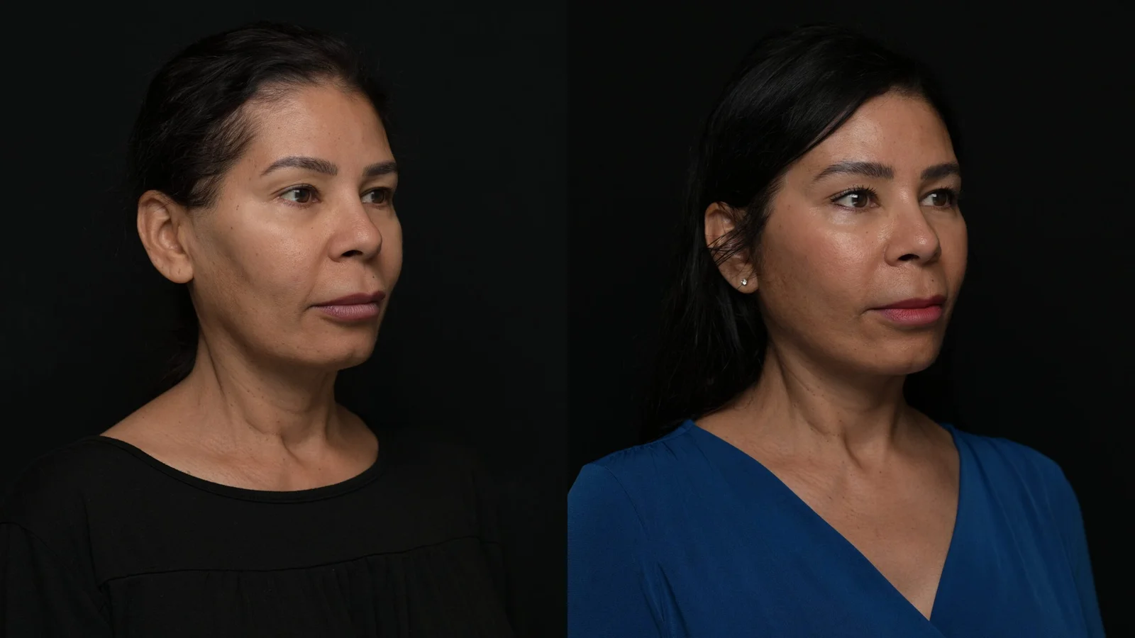 Before-and-after photograph, deep plane facelift and neck lift