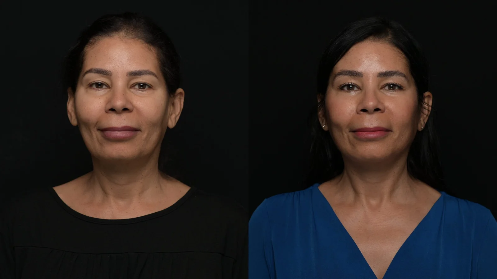 Before-and-after photograph, deep plane facelift and neck lift