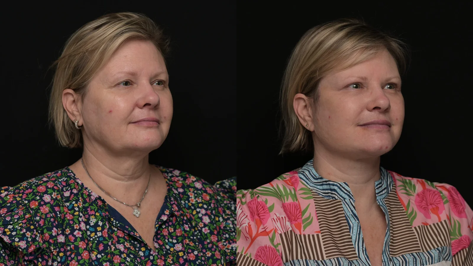 Before-and-after photograph, deep plane facelift and neck lift