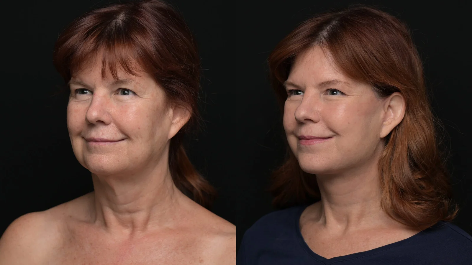 Before-and-after photograph, deep plane facelift and neck lift