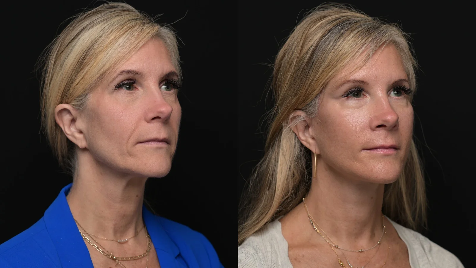 Before-and-after photograph, deep plane facelift and neck lift