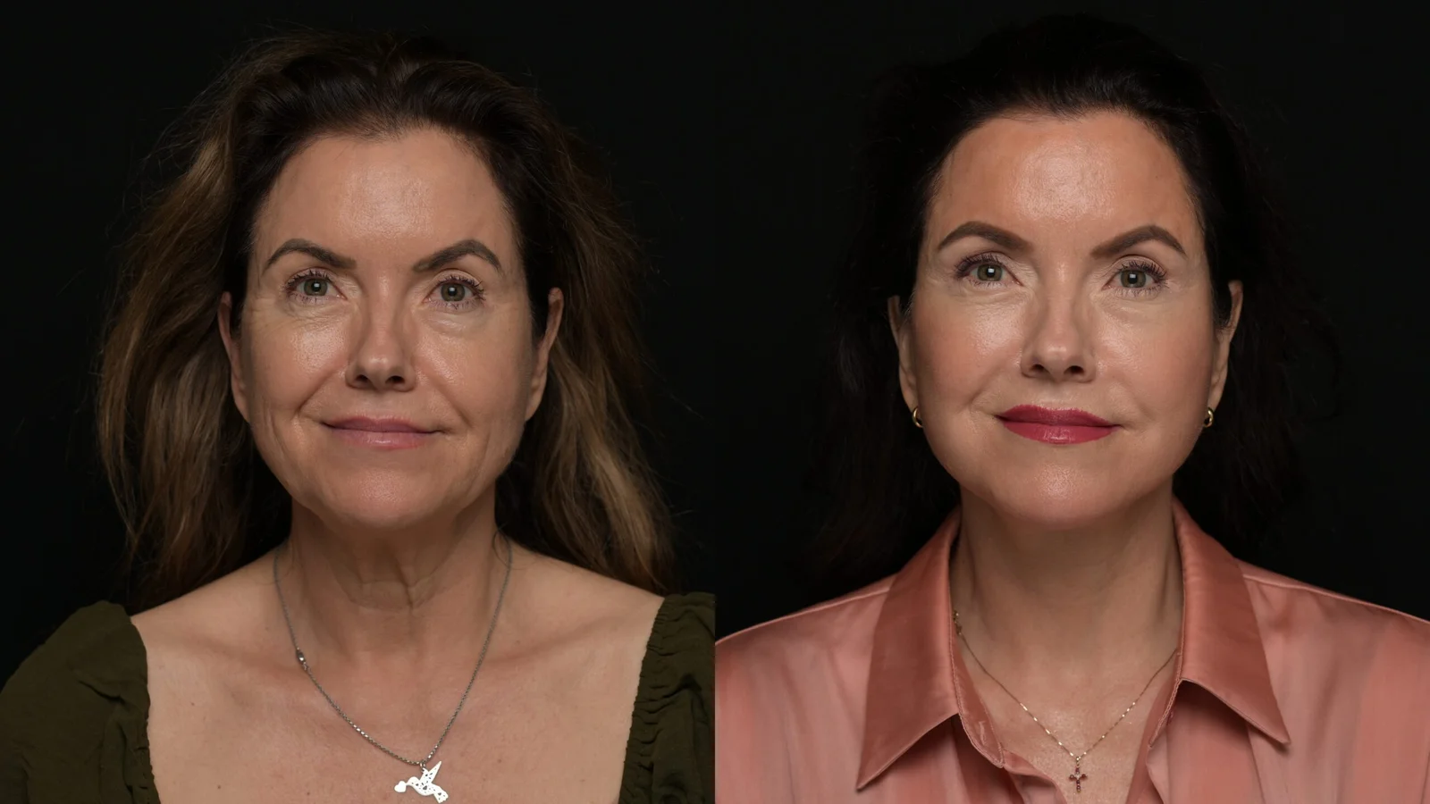 Before-and-after photograph, deep plane facelift and neck lift