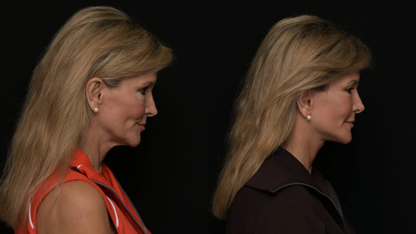 Before-and-after photograph, deep plane facelift and neck lift