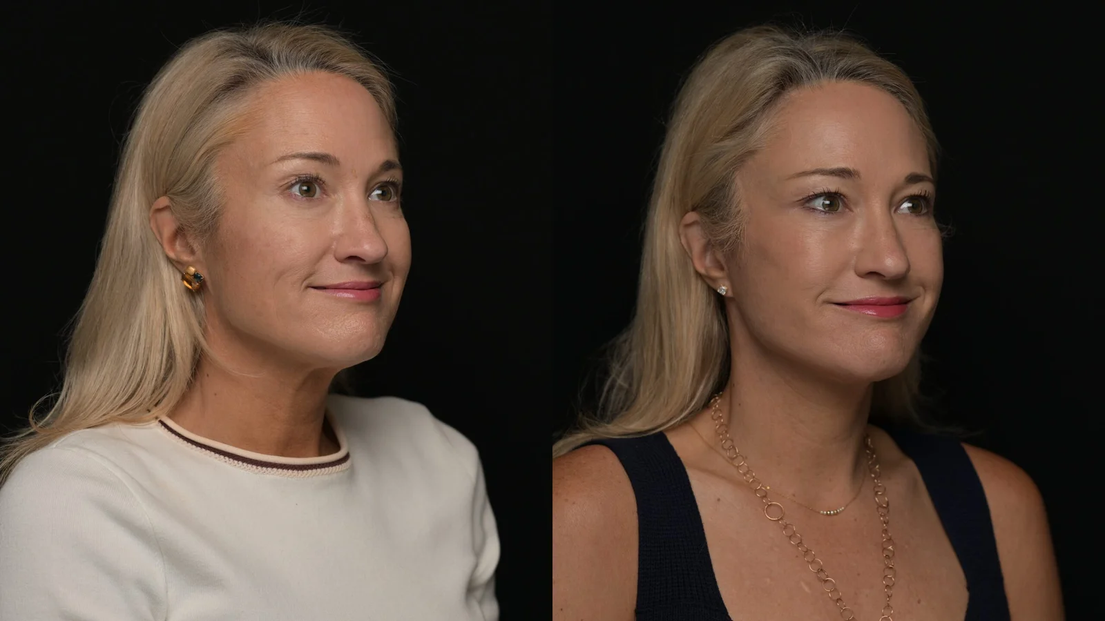 Before-and-after photograph, deep plane facelift and neck lift
