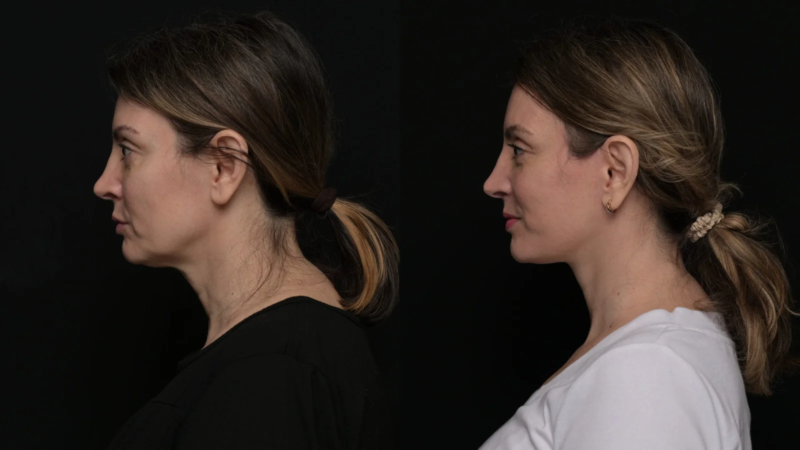 Before-and-after photograph, deep plane facelift and neck lift