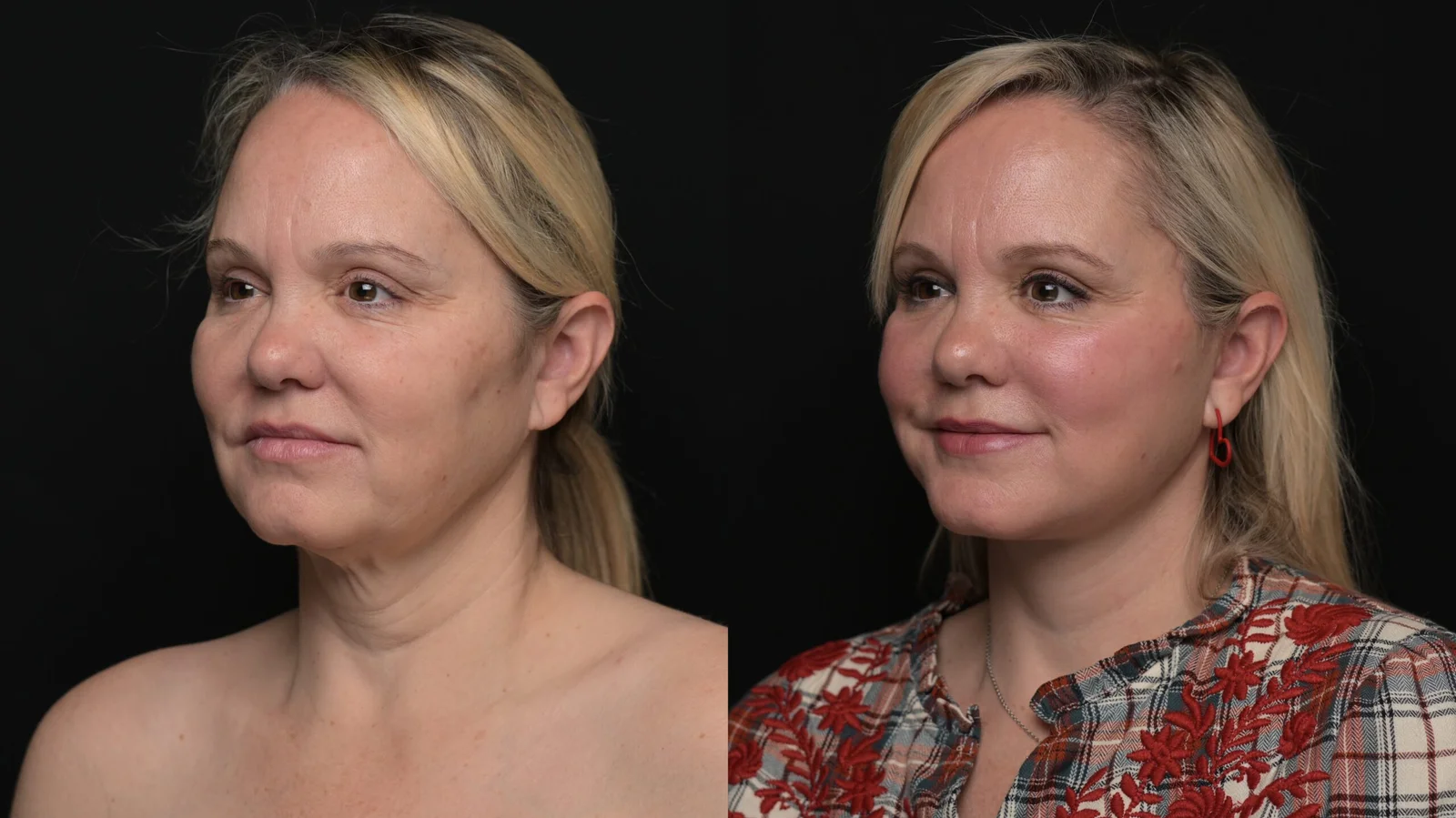 Before-and-after photograph, deep plane facelift and neck lift