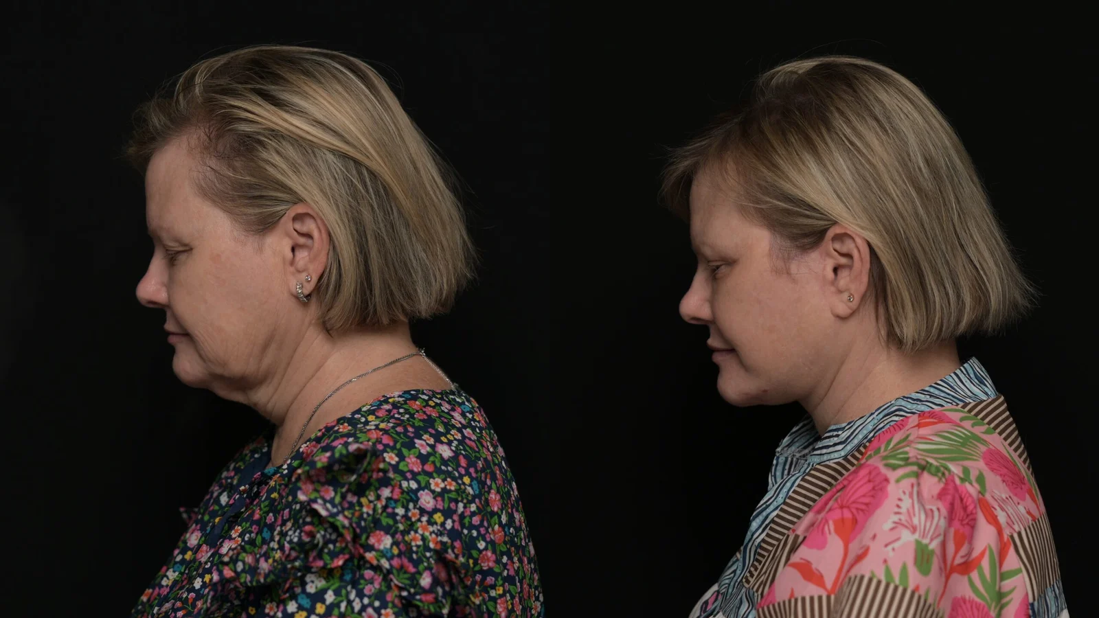 Before-and-after photograph, deep plane facelift and neck lift