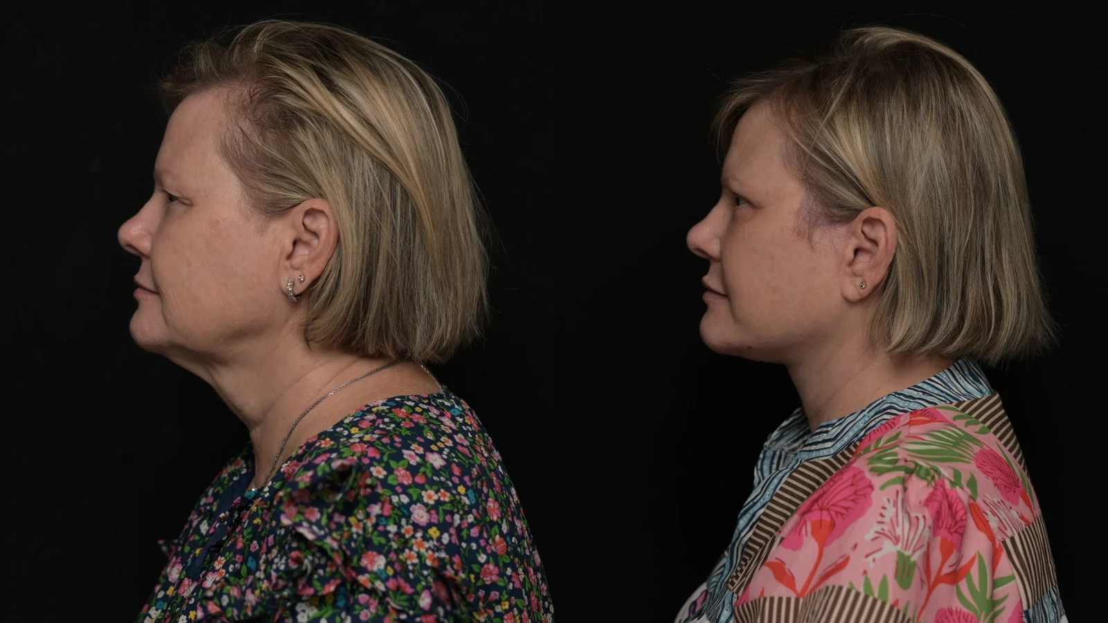 Before-and-after photograph, deep plane facelift and neck lift