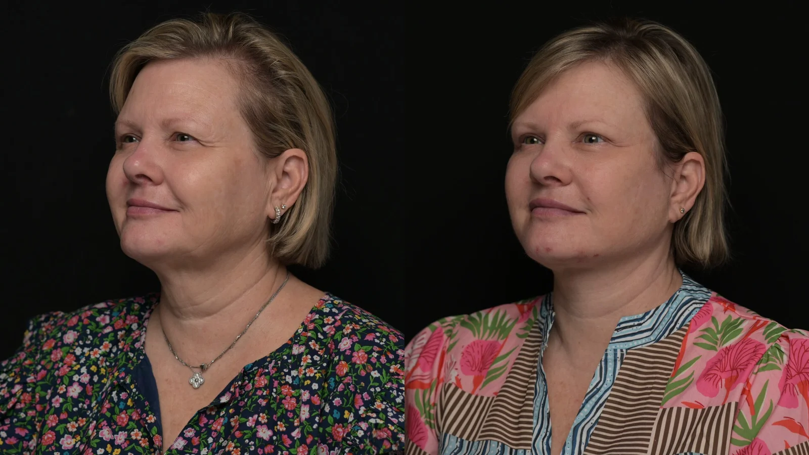 Before-and-after photograph, deep plane facelift and neck lift