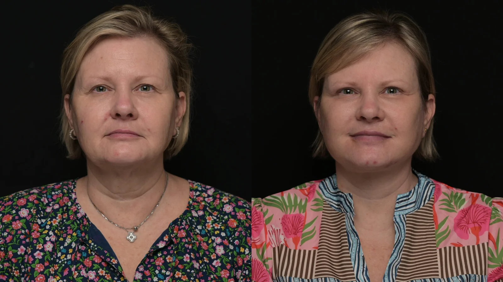 Before-and-after photograph, deep plane facelift and neck lift