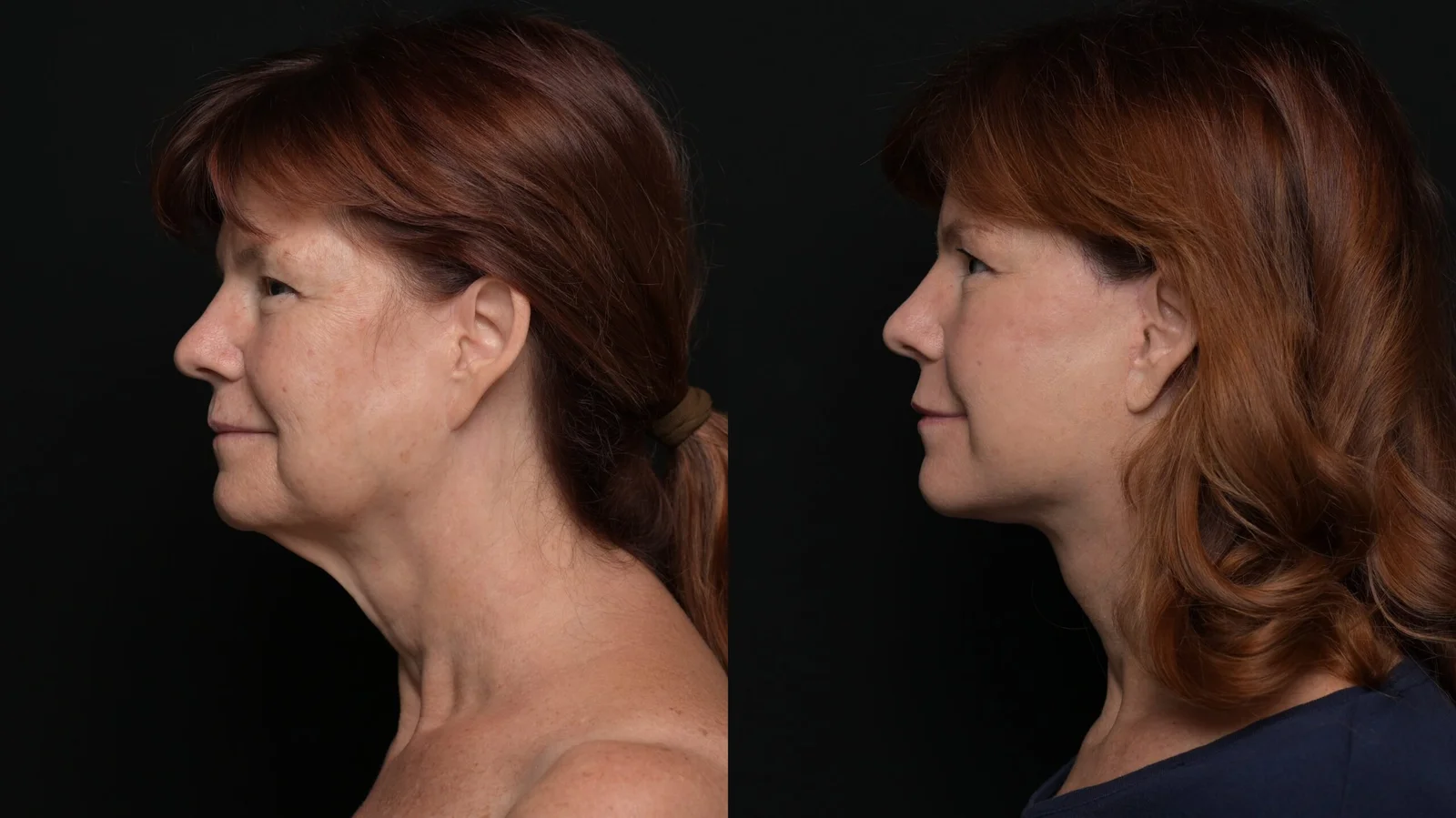 Before-and-after photograph, deep plane facelift and neck lift