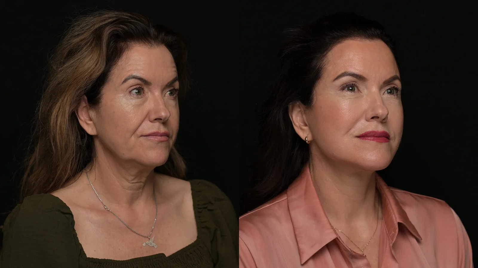 Before-and-after photograph, deep plane facelift and neck lift