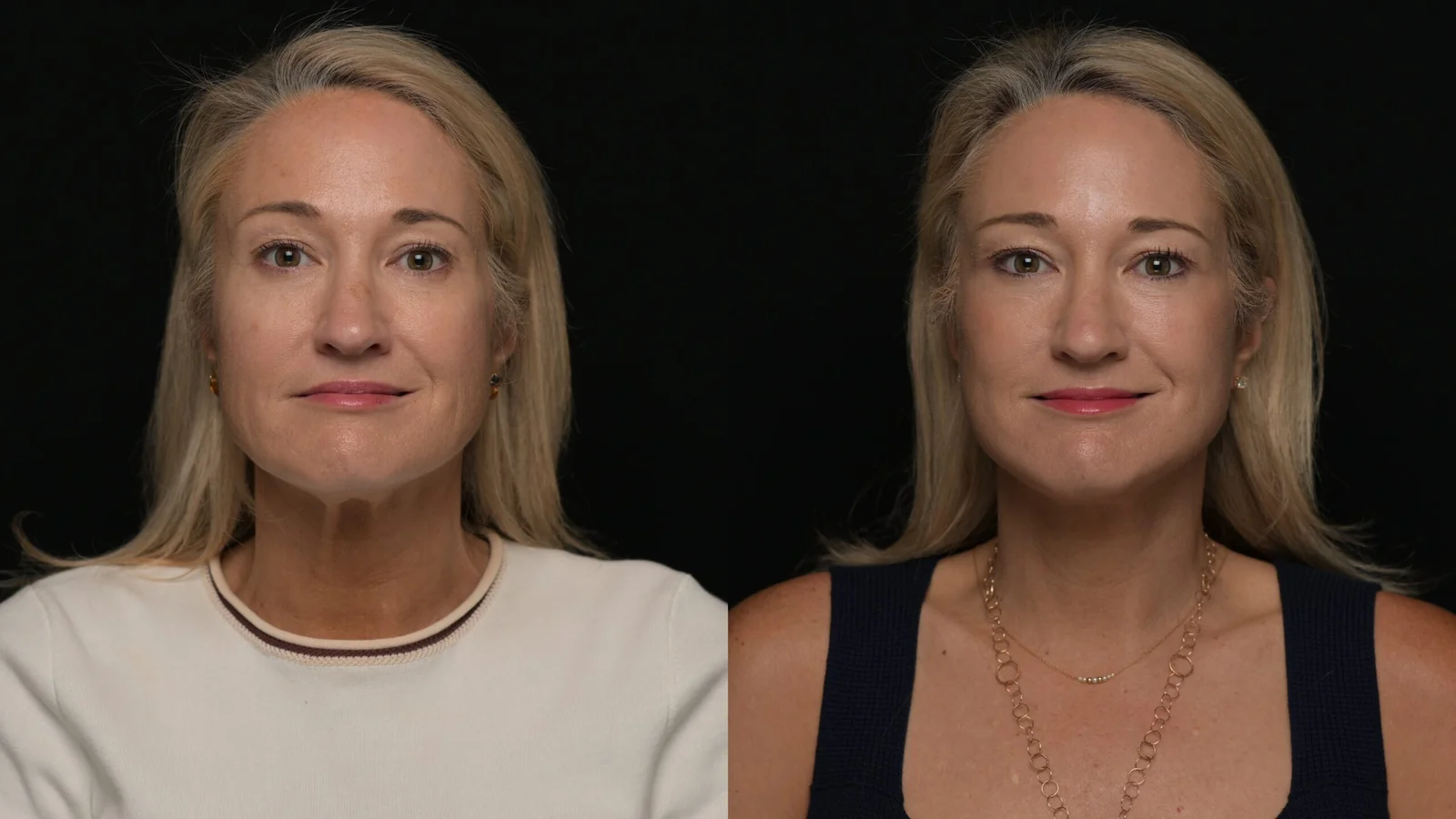 Before-and-after photograph, deep plane facelift and neck lift