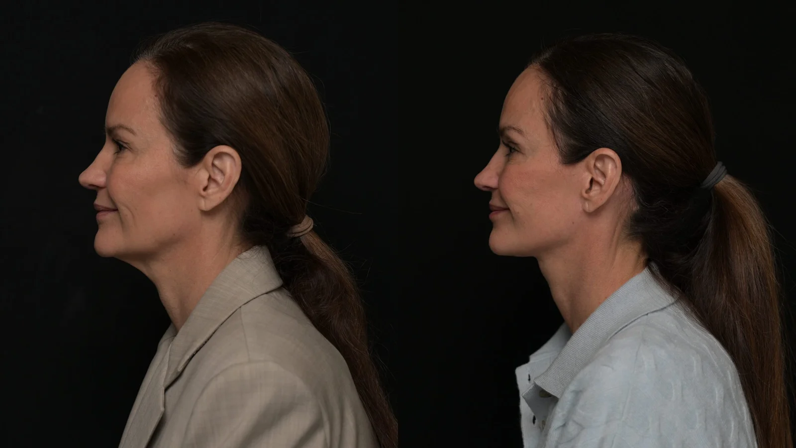 Before-and-after photograph, deep plane facelift and neck lift