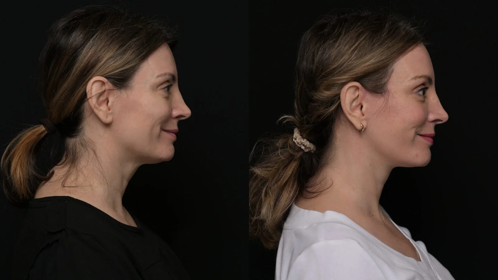 Before-and-after photograph, deep plane facelift and neck lift