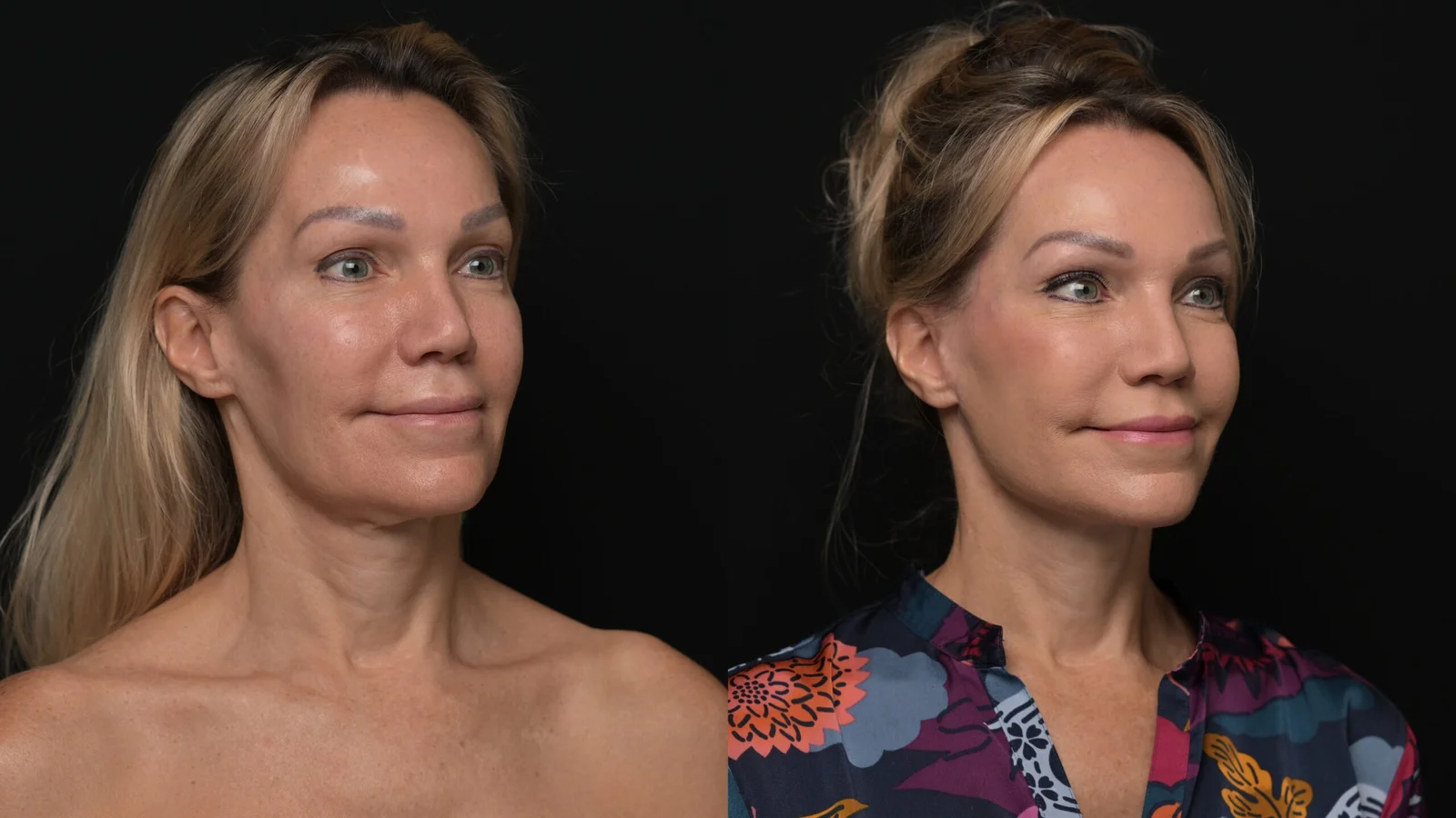 Before-and-after photograph, deep plane facelift and neck lift