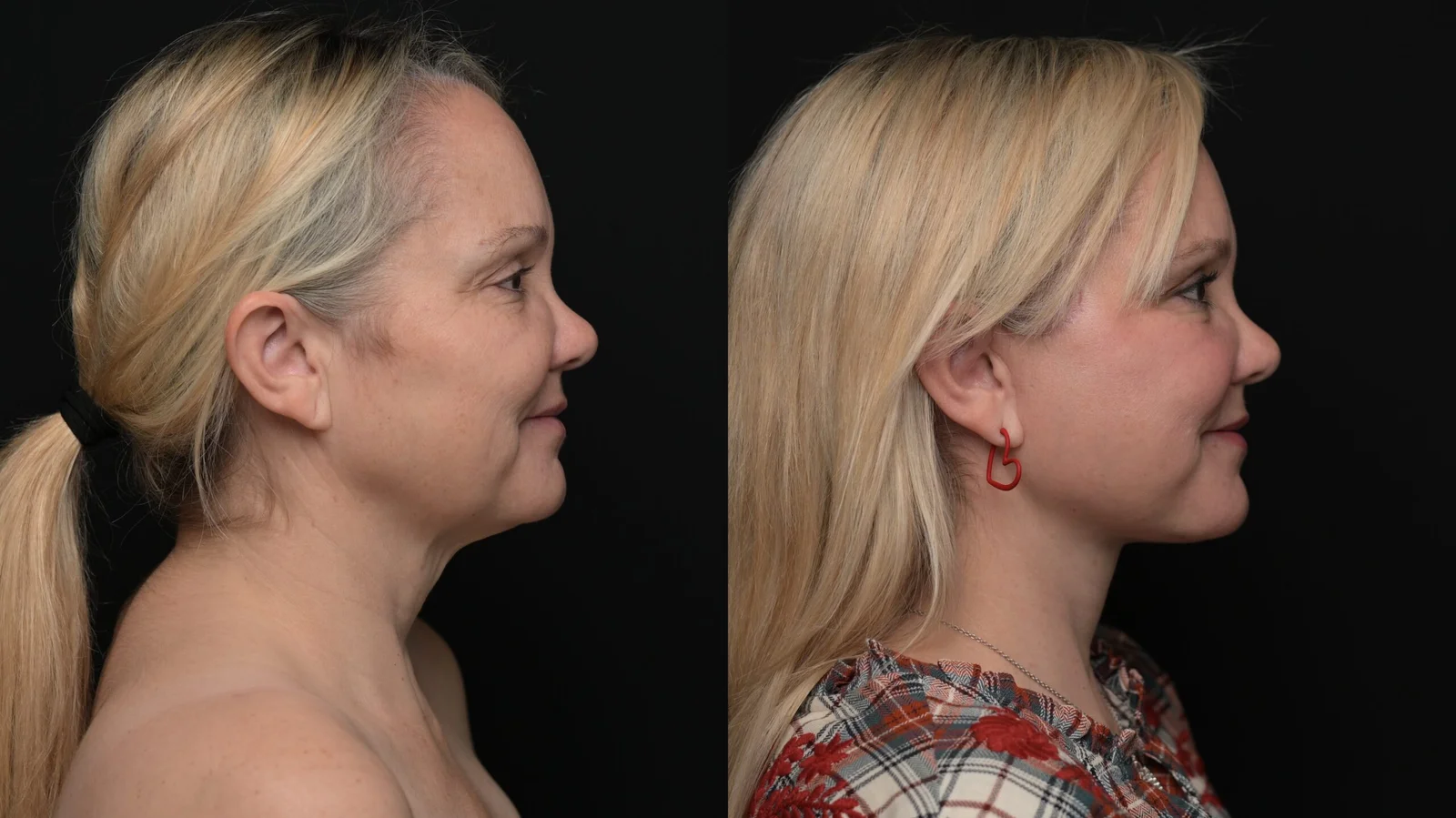 Before-and-after photograph, deep plane facelift and neck lift