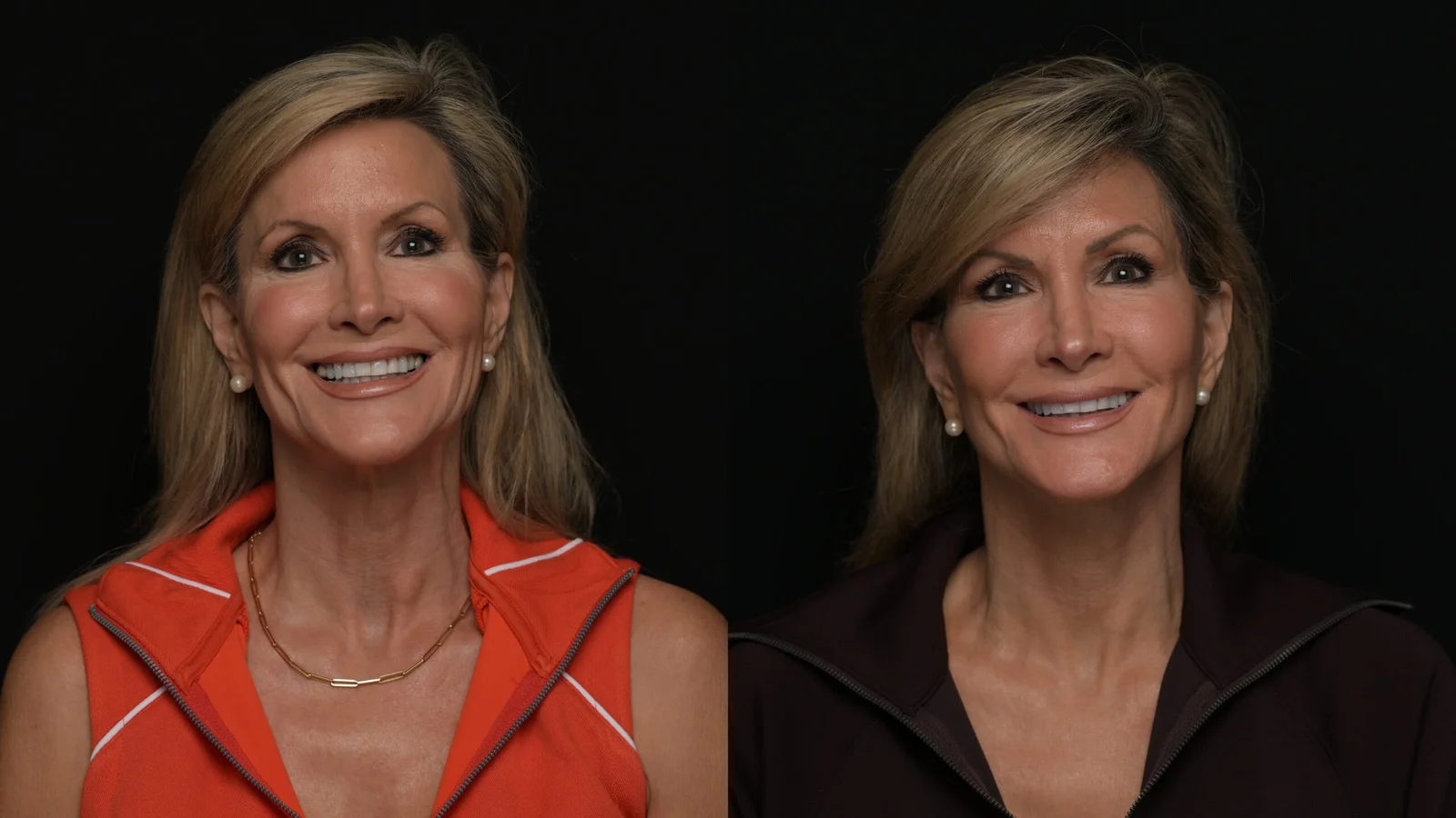 Before-and-after photograph, deep plane facelift and neck lift