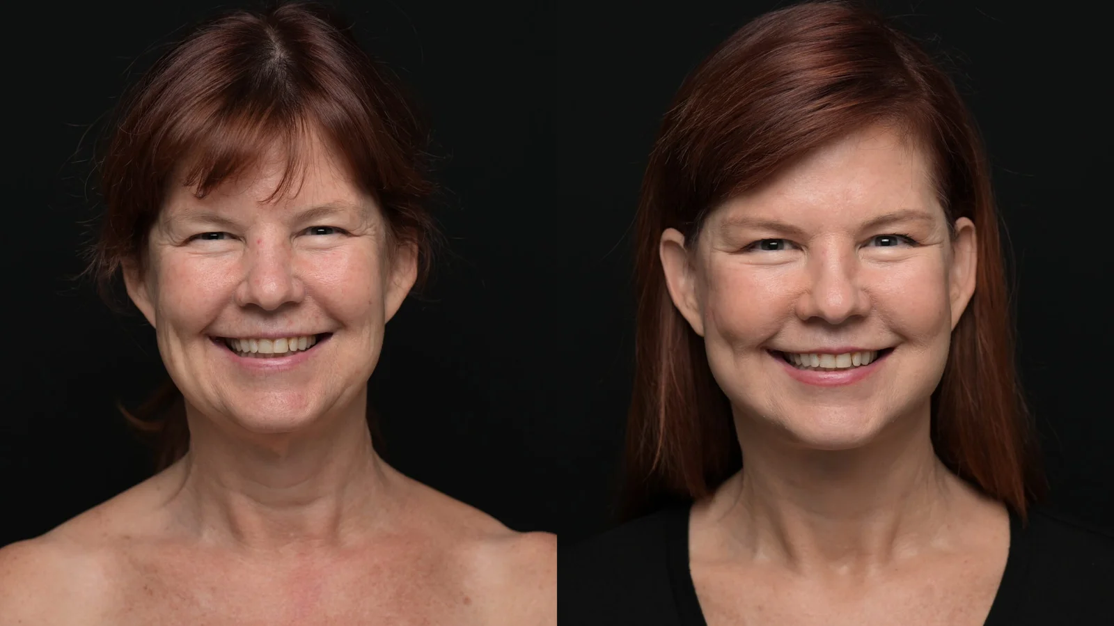 Before-and-after photograph, deep plane facelift and neck lift