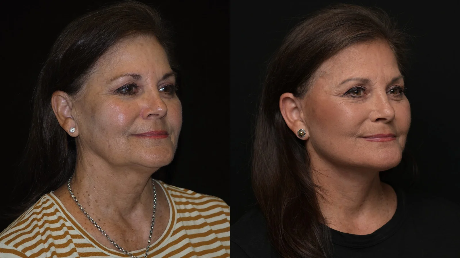Before-and-after photograph, deep plane facelift and neck lift