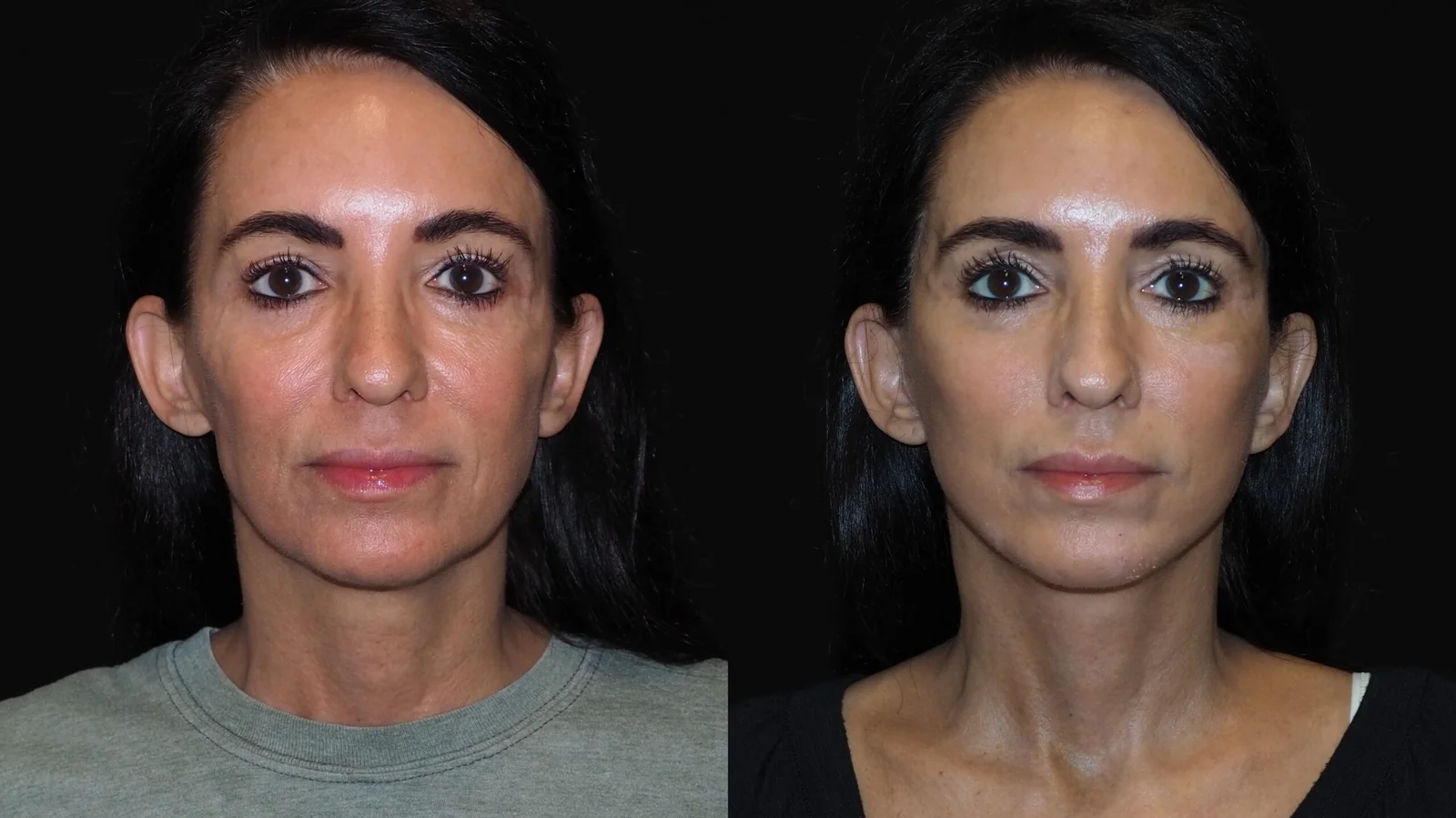 Before-and-after photograph, deep plane facelift and neck lift