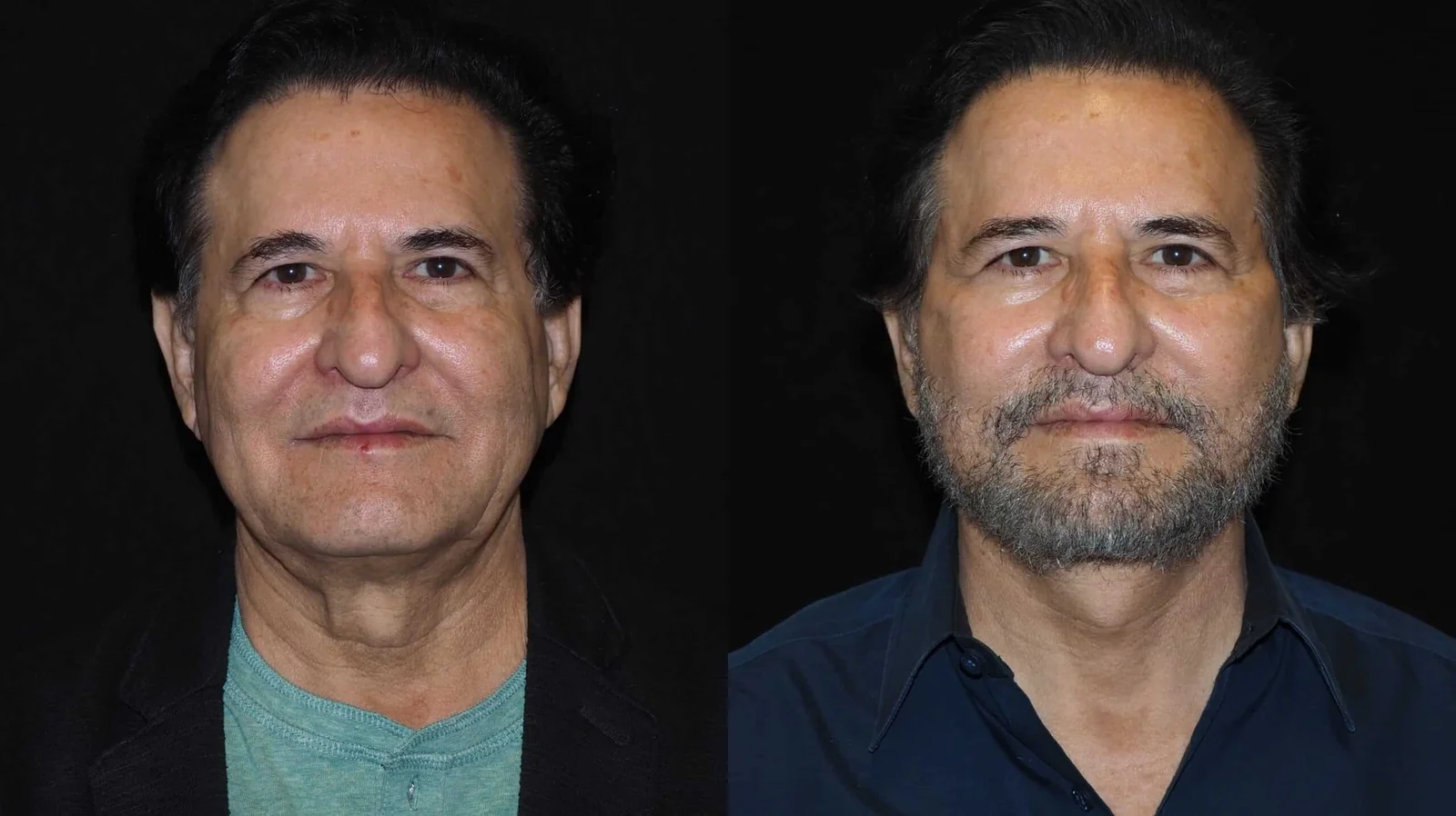 Before-and-after photograph, deep plane facelift and neck lift