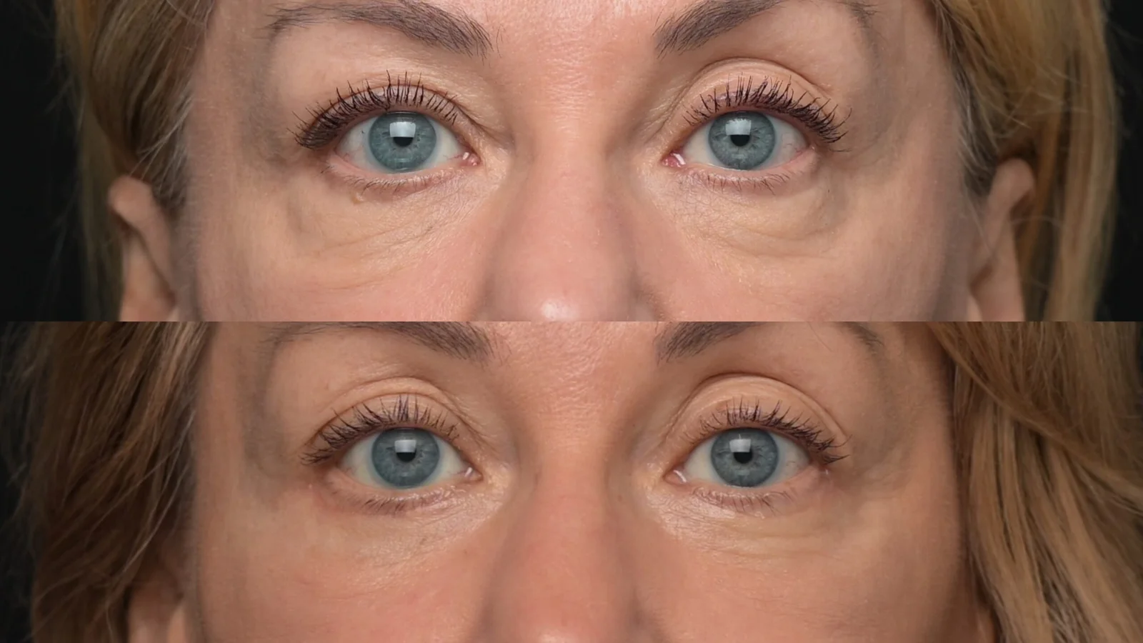 Before-and-after photograph, blepharoplasty