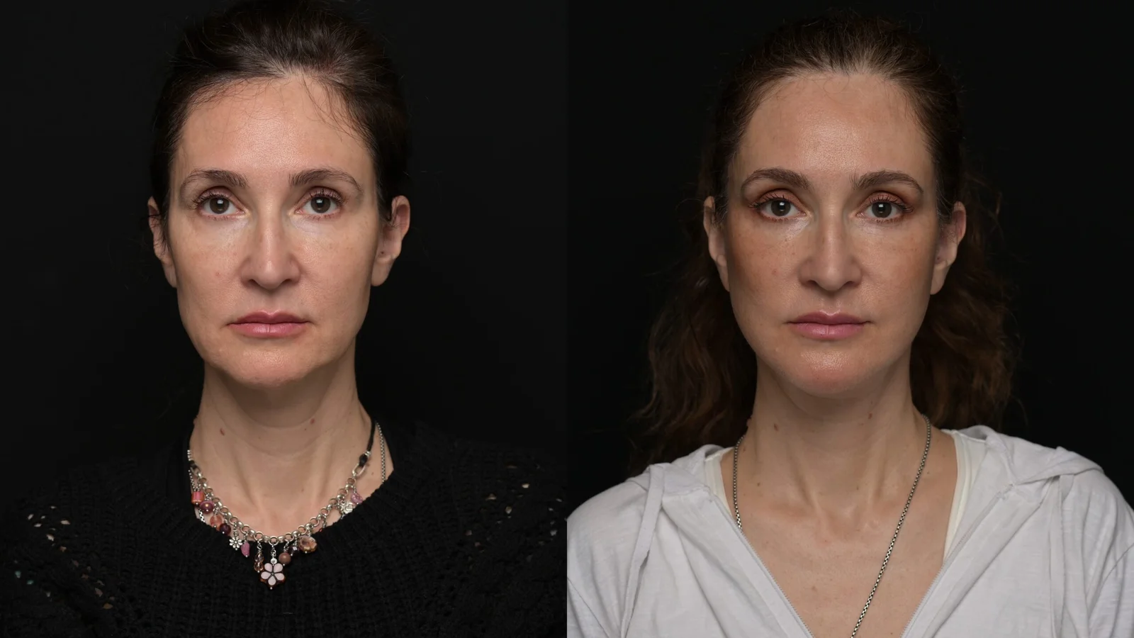 Before-and-after photograph, deep plane facelift and neck lift