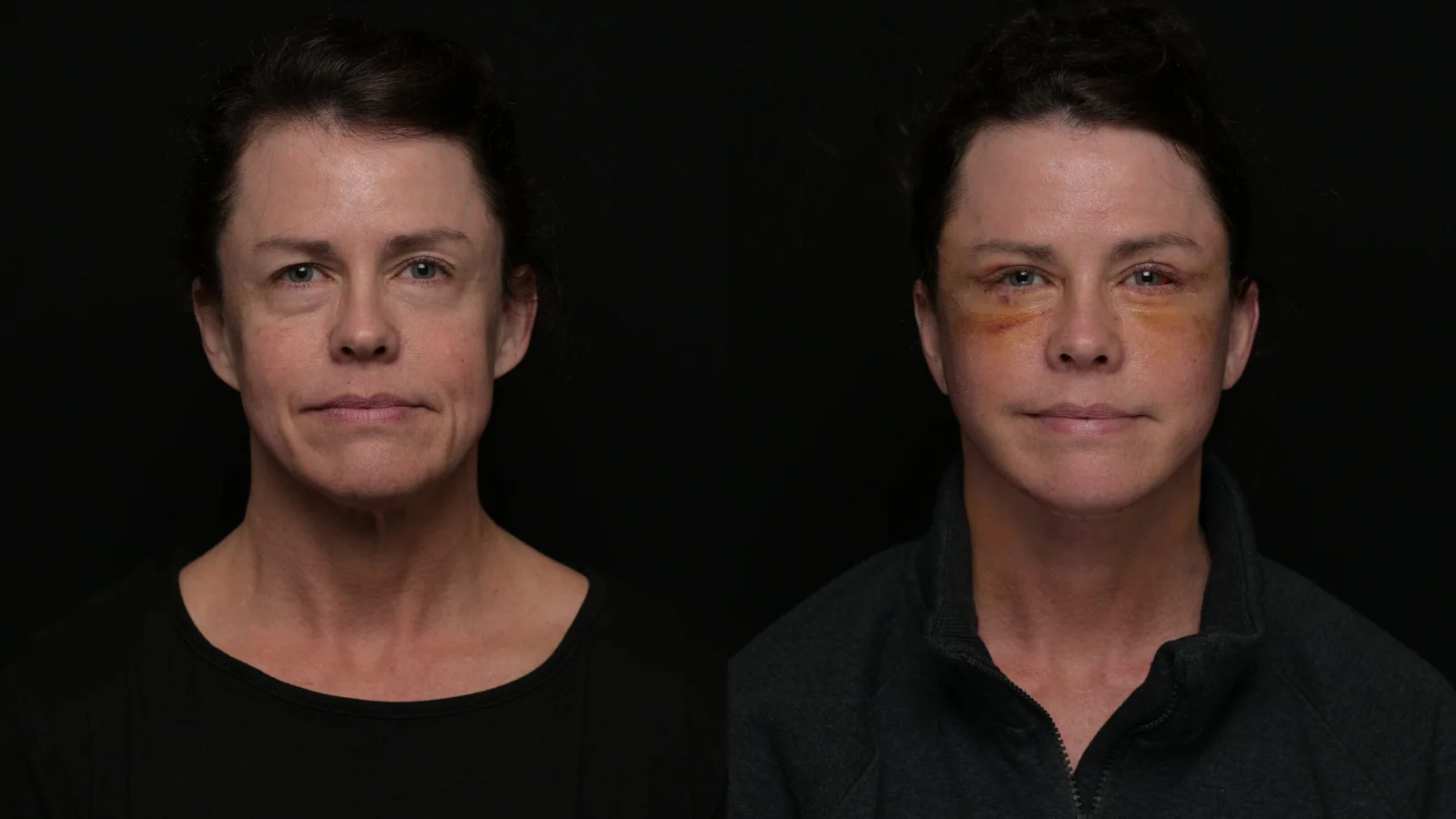 Before-and-after photograph, deep plane facelift and neck lift