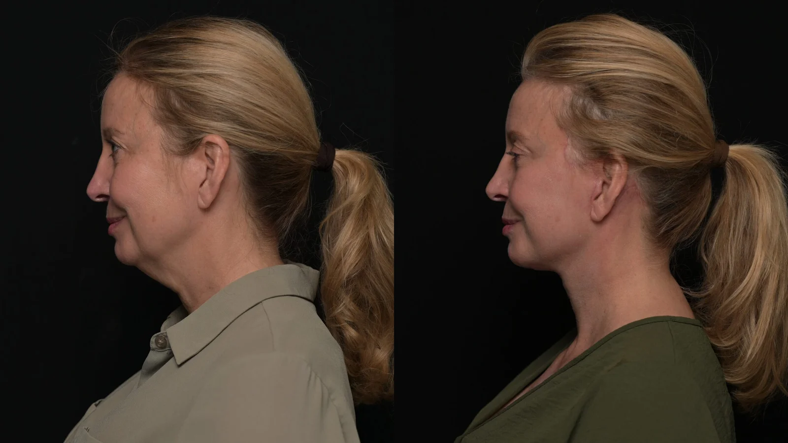 Before-and-after photograph, deep plane facelift and neck lift