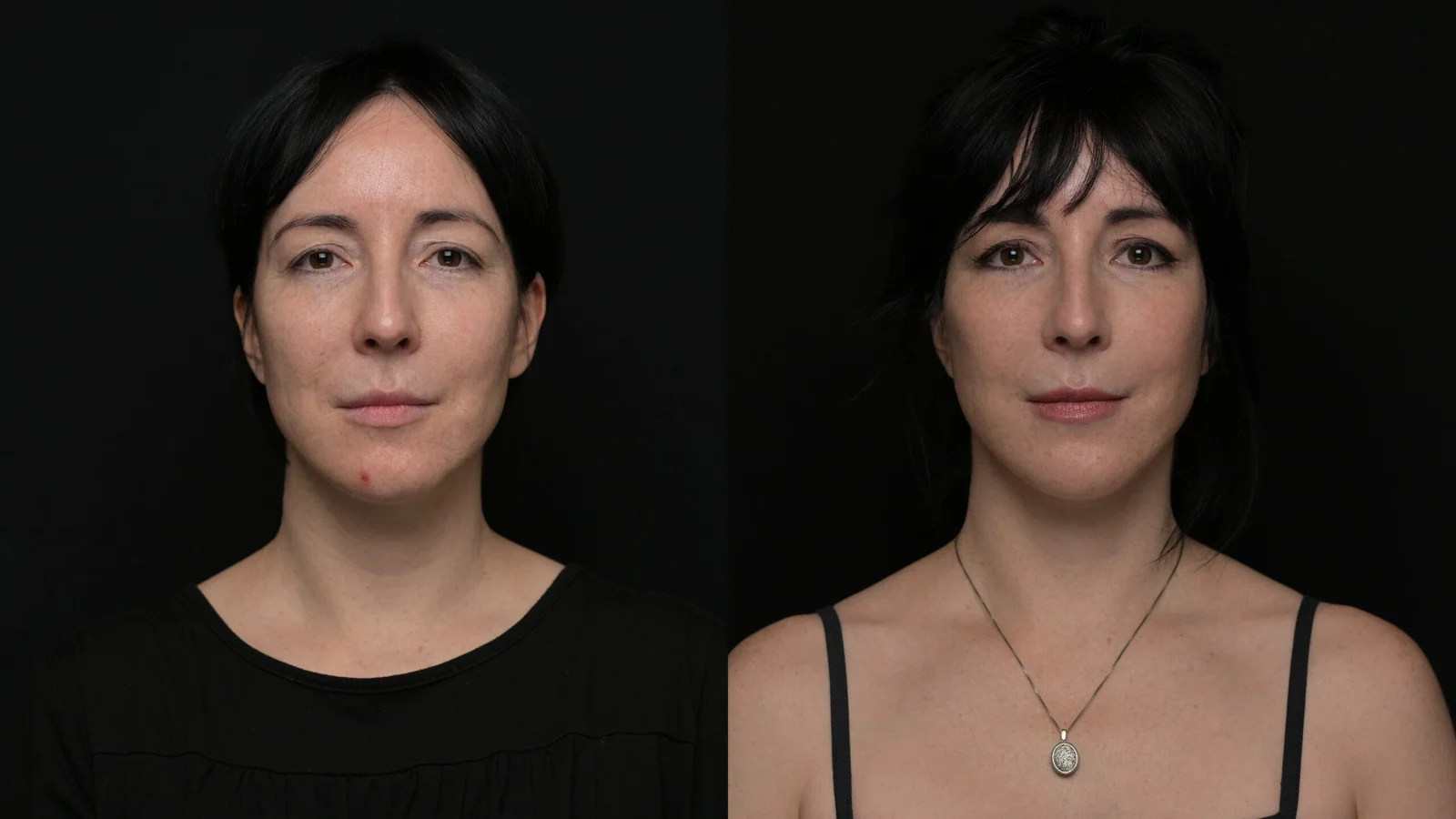 Before-and-after photograph, deep plane facelift and neck lift