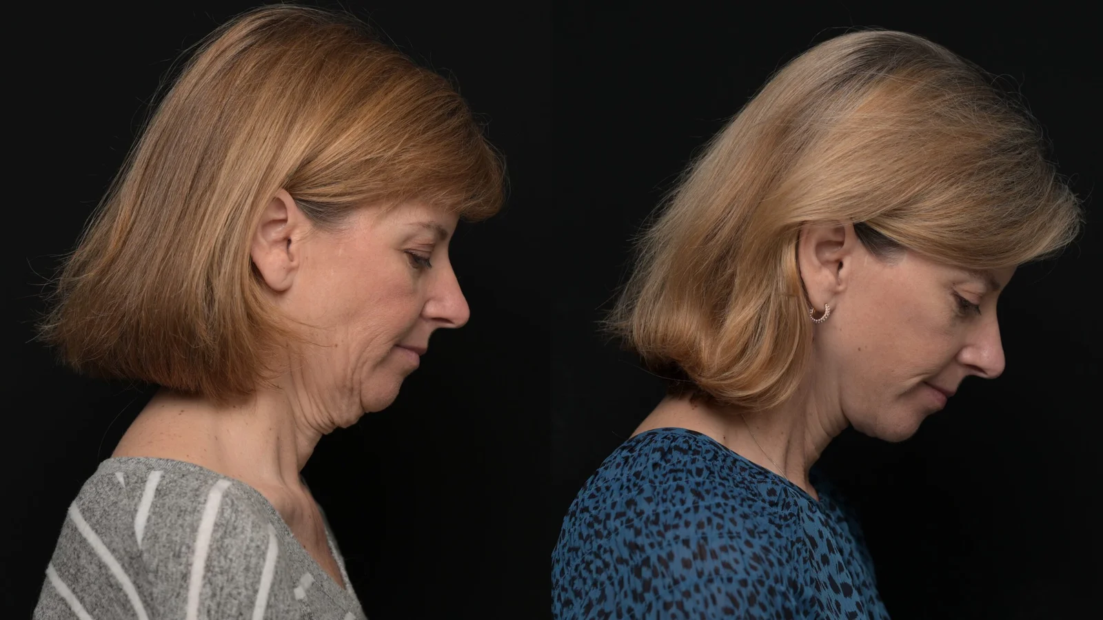 Before-and-after photograph, deep plane facelift and neck lift