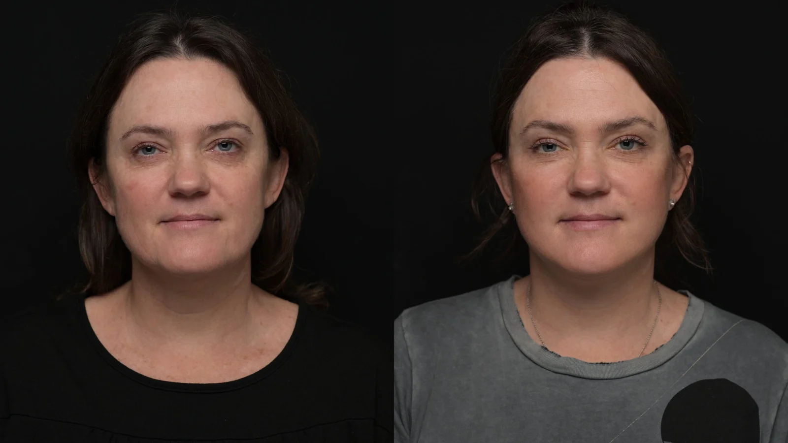 Before-and-after photograph, deep plane facelift and neck lift