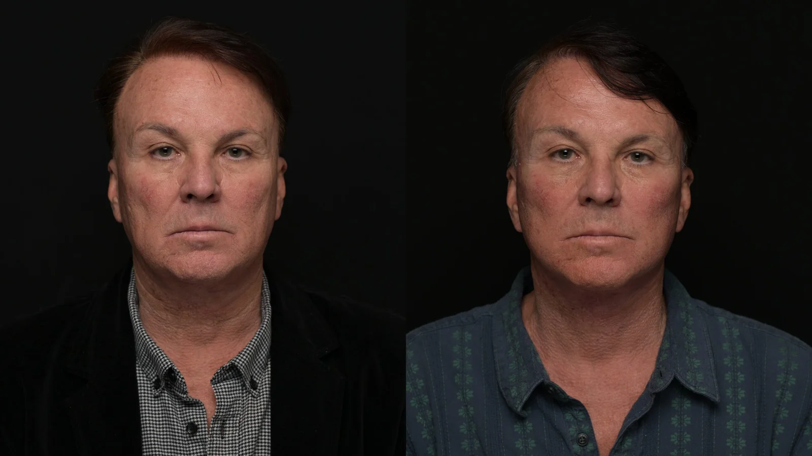 Before-and-after photograph, deep plane facelift and neck lift