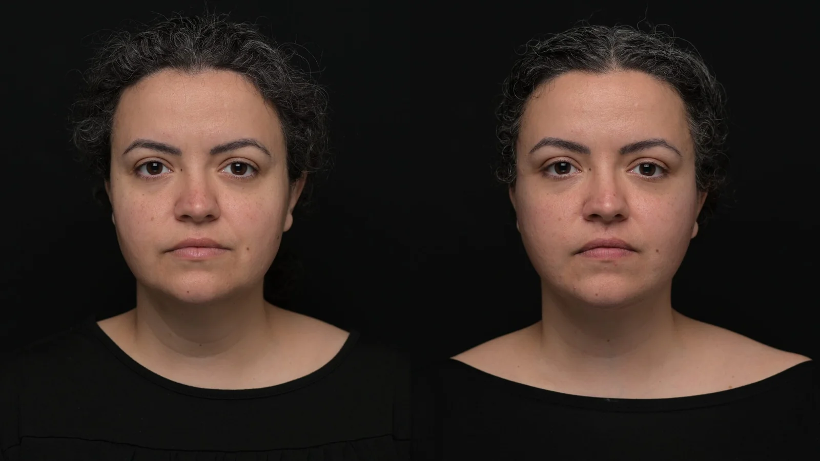 Before-and-after photograph, deep plane facelift and neck lift
