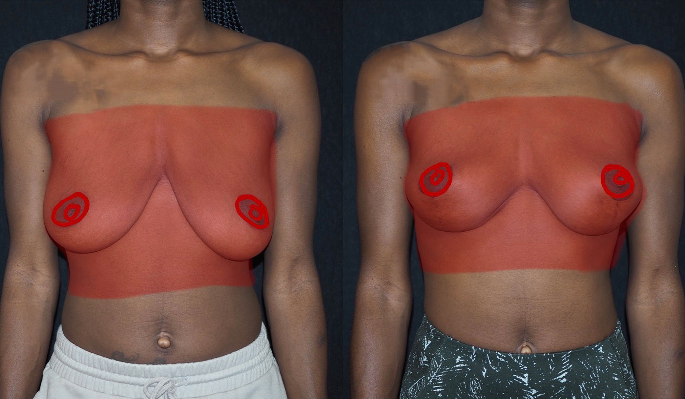 before and after breast augmentation