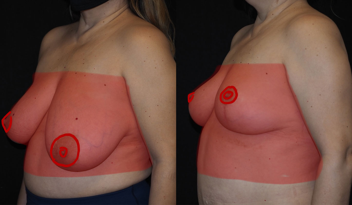 before and after breast reduction