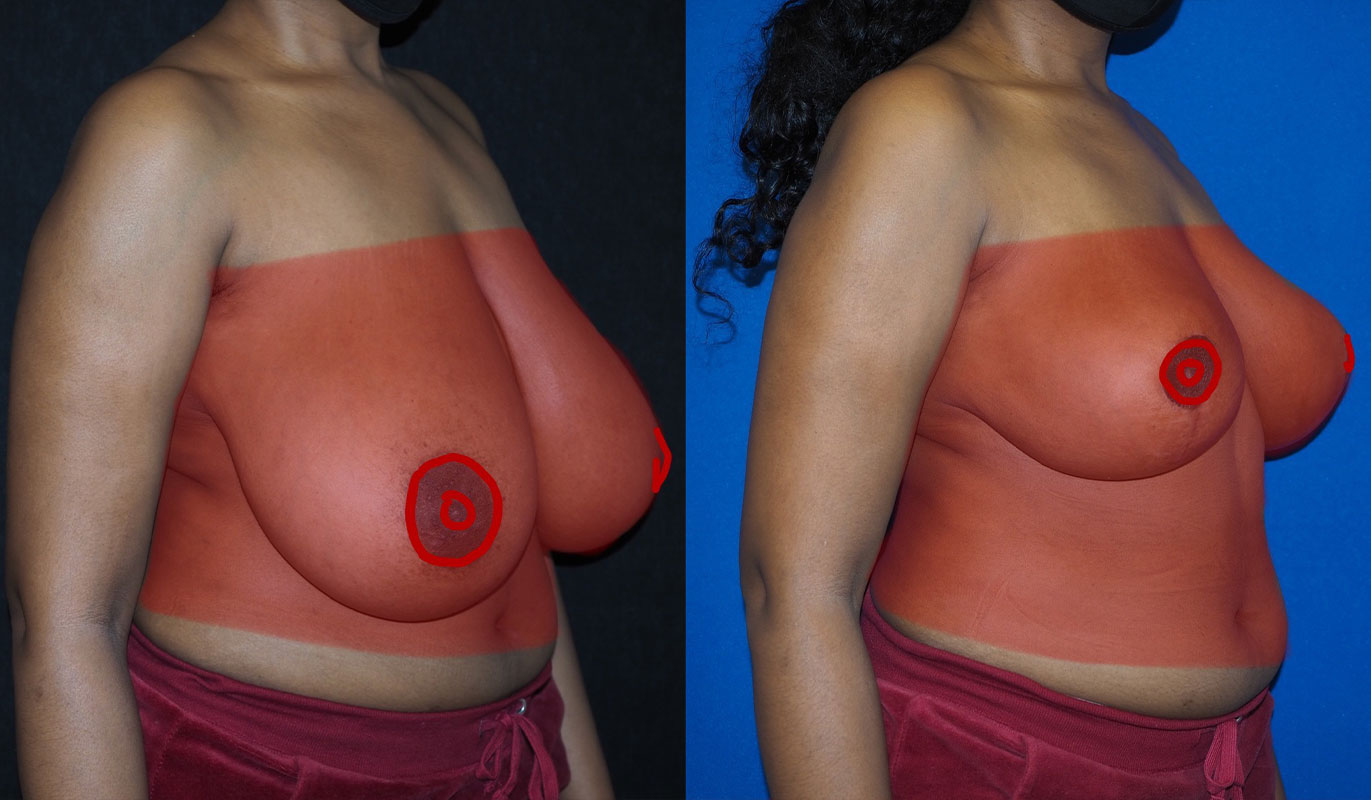 breast-reduction-10-2