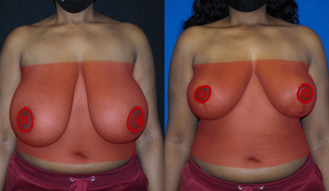 breast-reduction-10