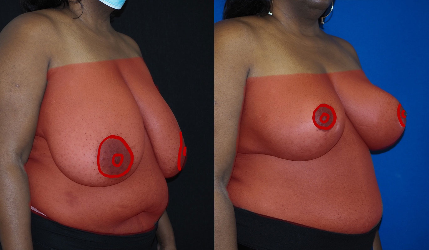 breast-reduction-11-2