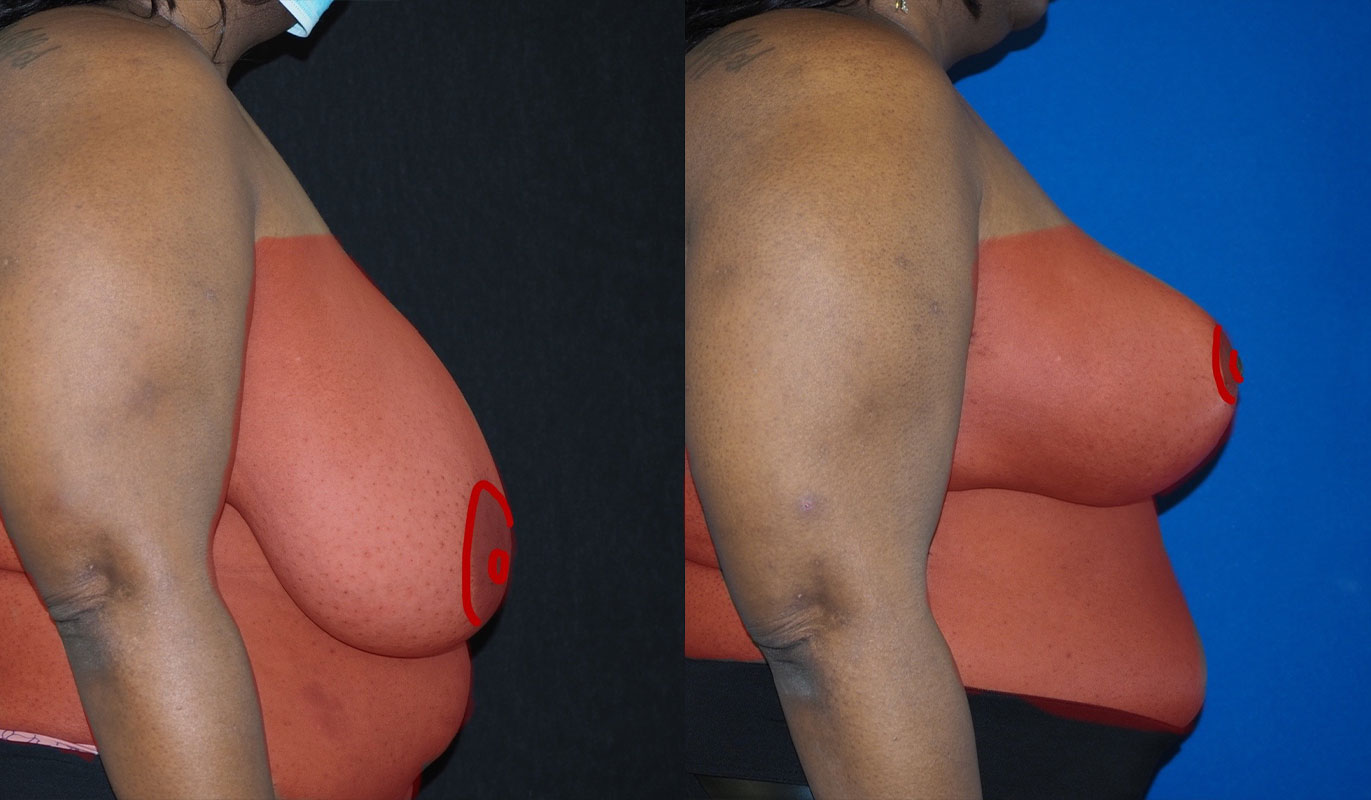 breast-reduction-11-3