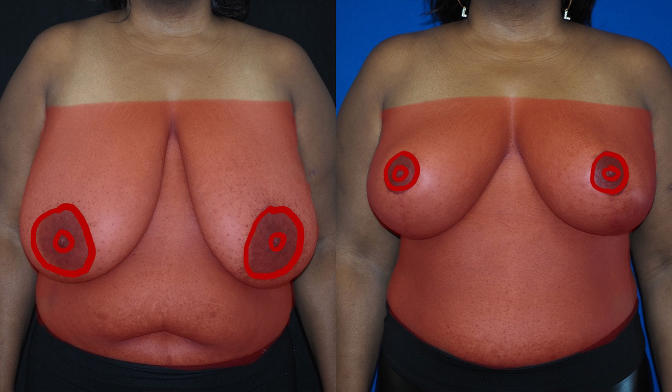 breast-reduction-11