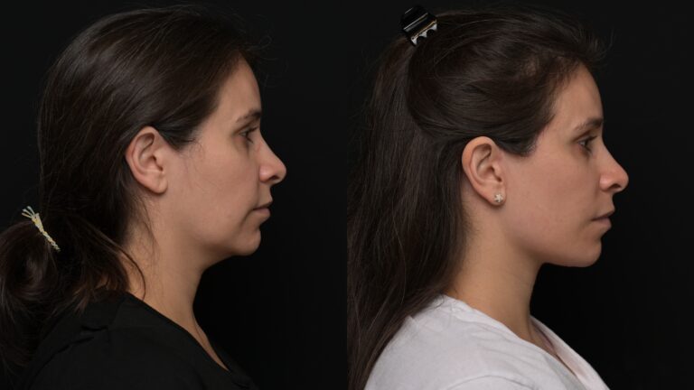 Facelift | Neck Lift 54 - Age: 35-40
Procedure: Deep Plane Facelift, Deep Neck Lift
Results at: 1 month