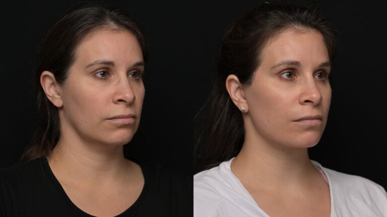 Facelift | Neck Lift 54 - Age: 35-40
Procedure: Deep Plane Facelift, Deep Neck Lift
Results at: 1 month